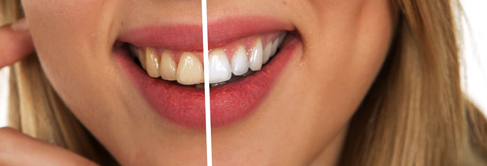 i want white teeth k&auml;ytt&ouml;ohje
